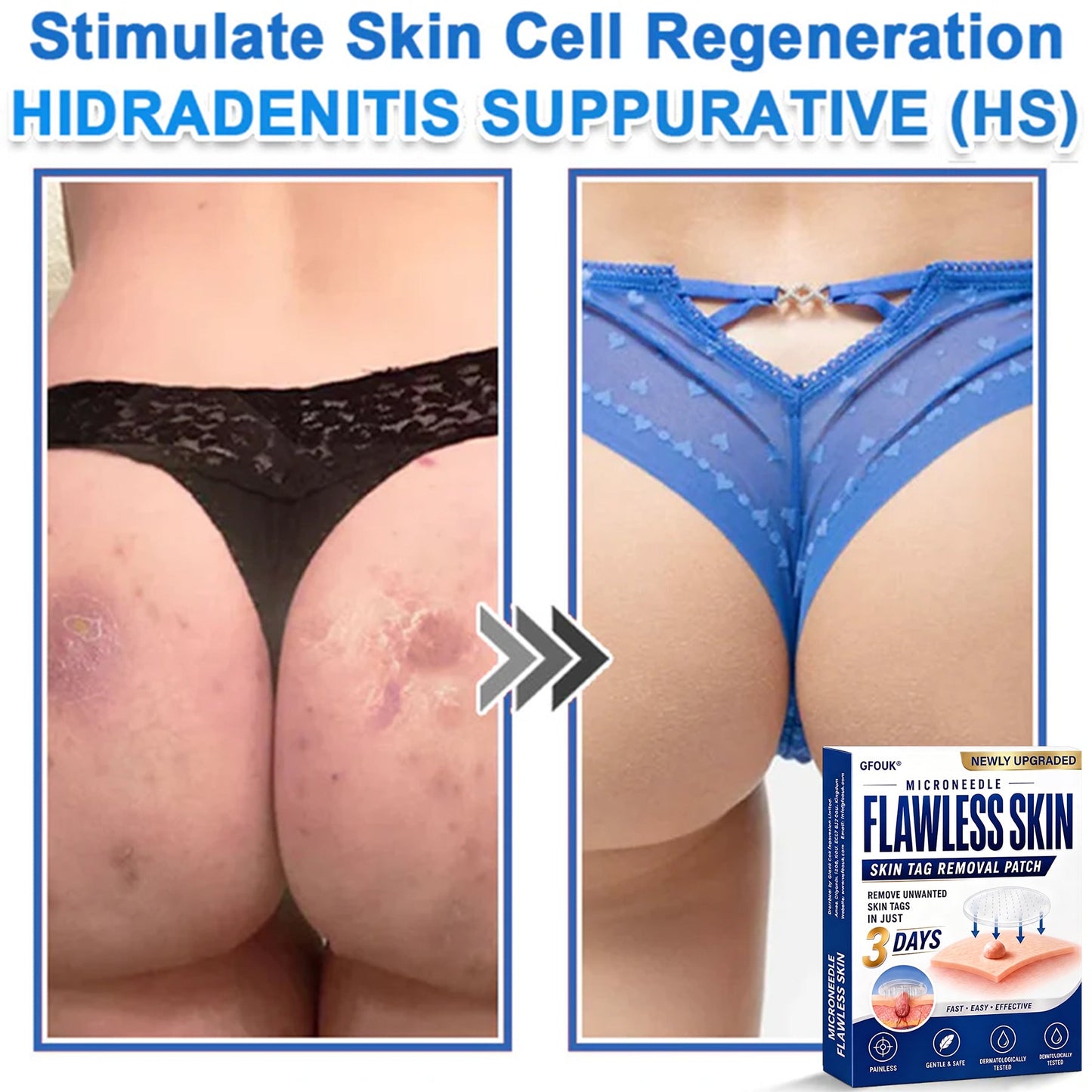 💎GFOUK® 2026 Newly Upgraded 2-in-1 Microneedle Hydrocolloid Patches | Removes Raised Moles, Acne, Flat Warts, and Skin Tags | Improves Wrinkles, Scars, and Blemishes | Invisible Acne Patches for Face & Body